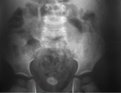 Radiografía de abdomen